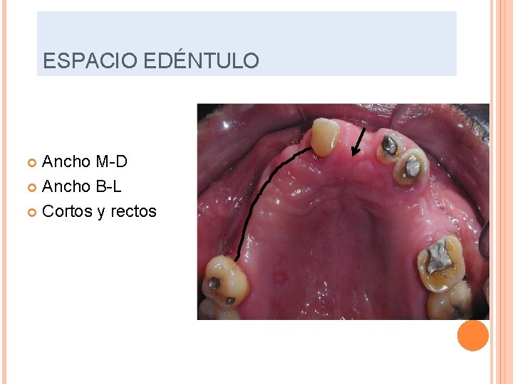 ESPACIO EDÉNTULO Ancho M-D Ancho B-L Cortos y rectos 