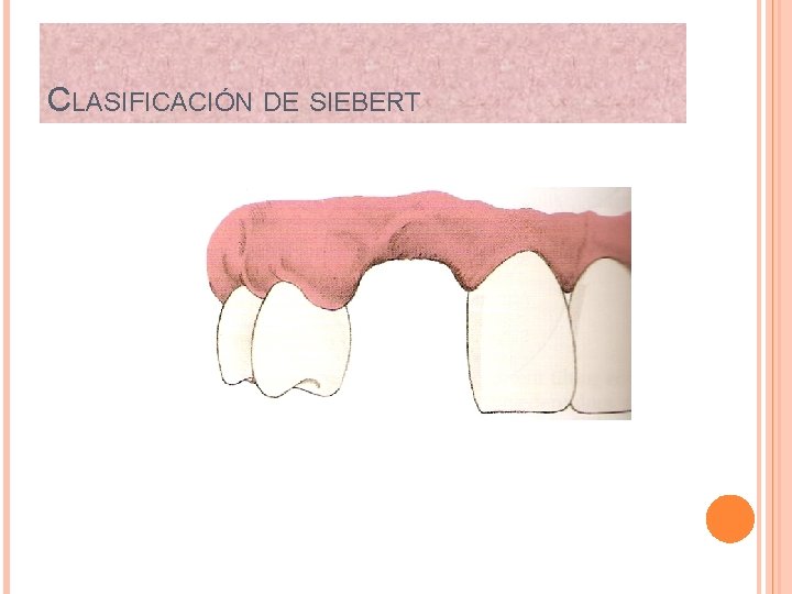 CLASIFICACIÓN DE SIEBERT 