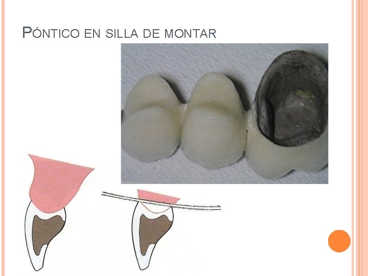 PÓNTICO EN SILLA DE MONTAR 