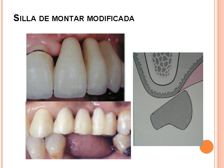 SILLA DE MONTAR MODIFICADA 