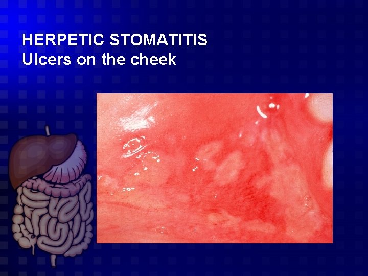 HERPETIC STOMATITIS Ulcers on the cheek 