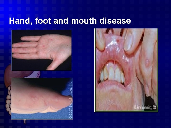 Hand, foot and mouth disease 