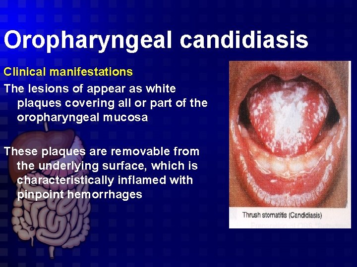 Oropharyngeal candidiasis Clinical manifestations The lesions of appear as white plaques covering all or