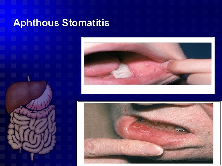 Aphthous Stomatitis 