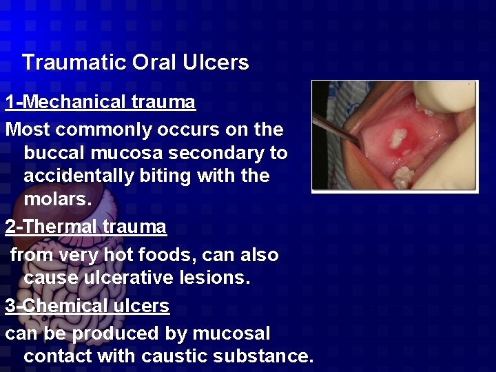 Traumatic Oral Ulcers 1 -Mechanical trauma Most commonly occurs on the buccal mucosa secondary