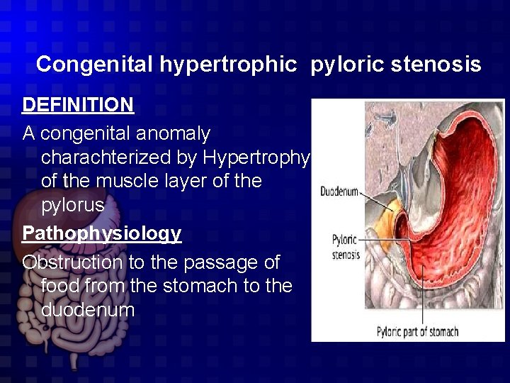 Congenital hypertrophic pyloric stenosis DEFINITION A congenital anomaly charachterized by Hypertrophy of the muscle