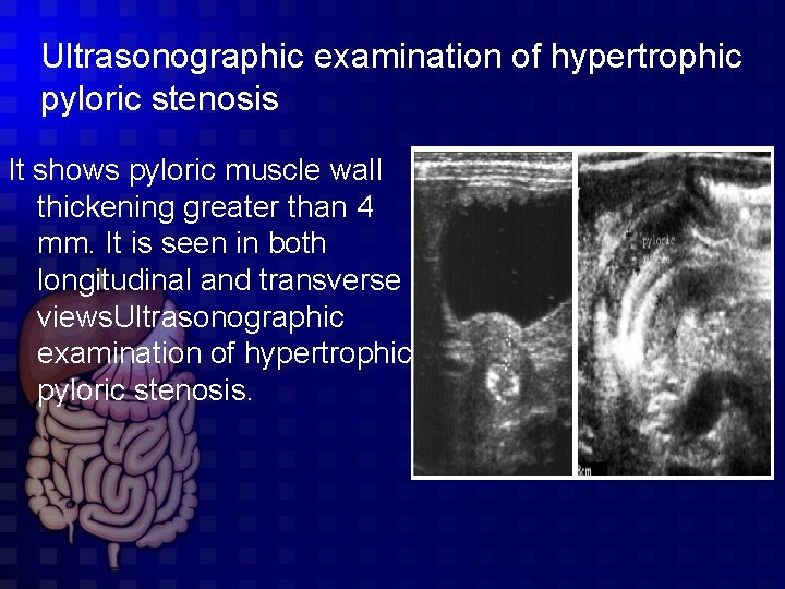 Ultrasonographic examination of hypertrophic pyloric stenosis It shows pyloric muscle wall thickening greater than