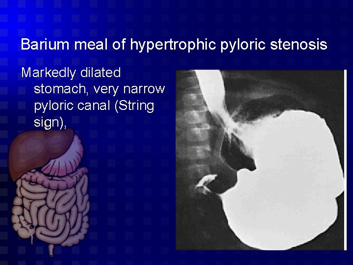 Barium meal of hypertrophic pyloric stenosis Markedly dilated stomach, very narrow pyloric canal (String