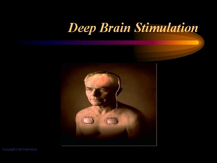 Deep Brain Stimulation Copyright L M Drummond 