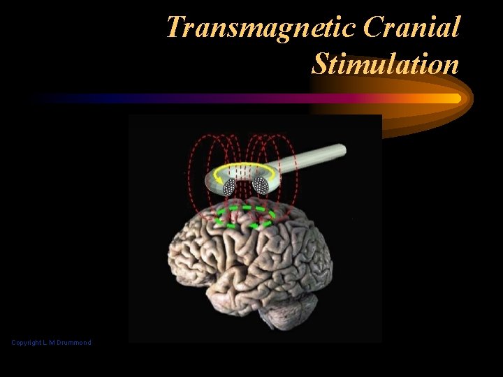 Transmagnetic Cranial Stimulation Copyright L M Drummond 