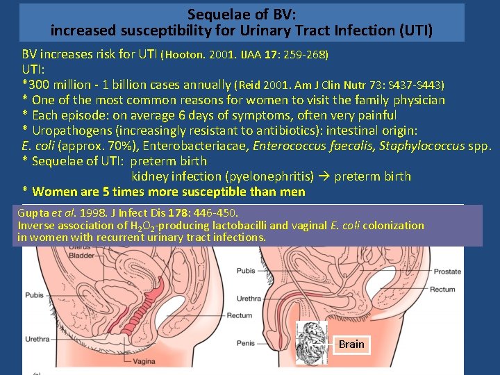 Sequelae of BV: increased susceptibility for Urinary Tract Infection (UTI) BV increases risk for