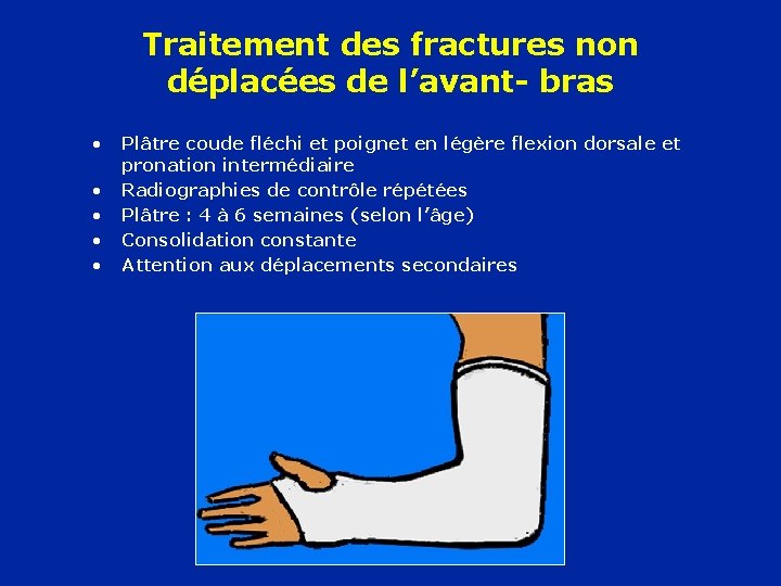 Traitement des fractures non déplacées de l’avant- bras • • • Plâtre coude fléchi