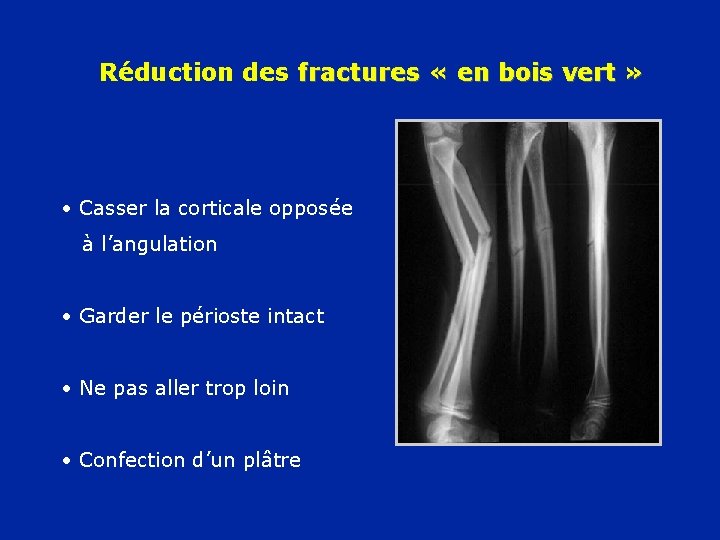 Réduction des fractures « en bois vert » • Casser la corticale opposée à