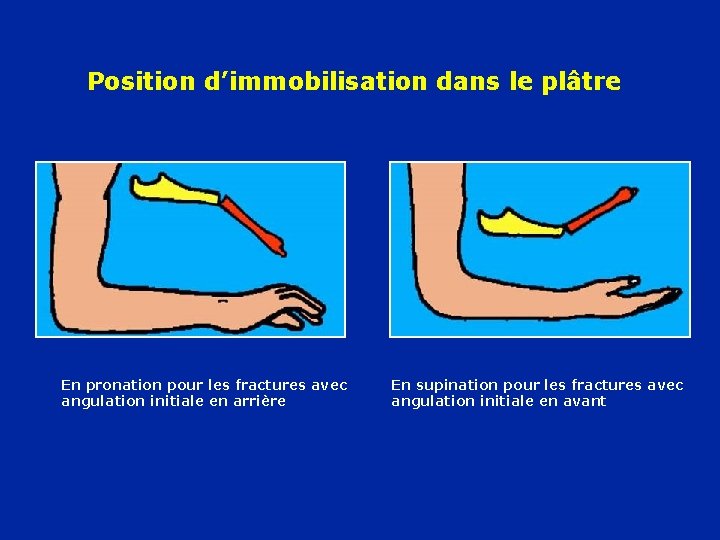 Position d’immobilisation dans le plâtre En pronation pour les fractures avec angulation initiale en