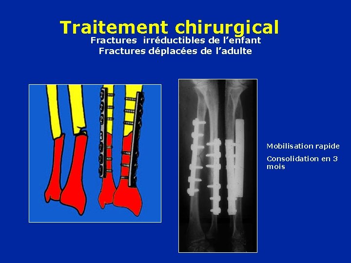 Traitement chirurgical Fractures irréductibles de l’enfant Fractures déplacées de l’adulte Mobilisation rapide Consolidation en