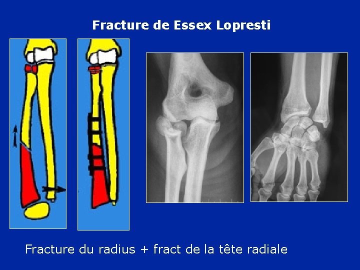 Fracture de Essex Lopresti Fracture du radius + fract de la tête radiale 