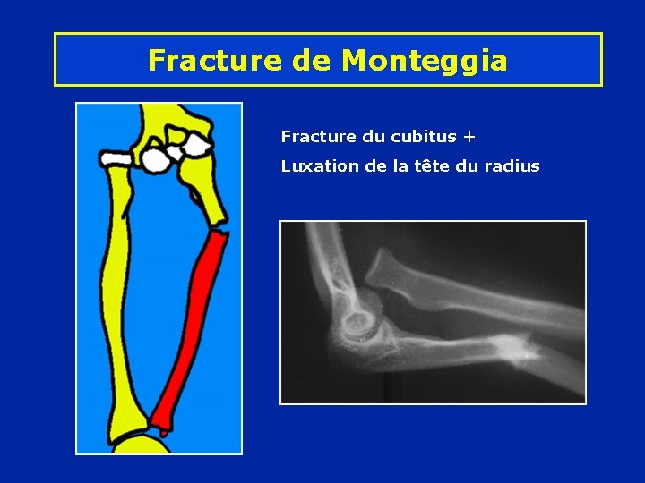 Fracture de Monteggia Fracture du cubitus + Luxation de la tête du radius 