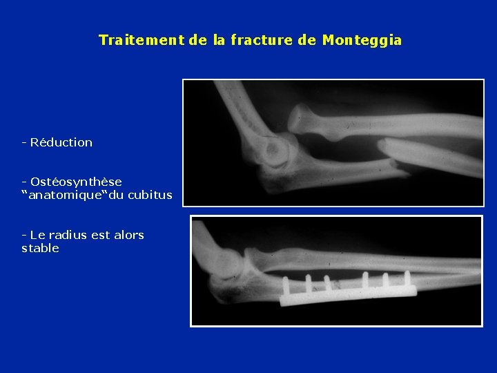 Traitement de la fracture de Monteggia - Réduction - Ostéosynthèse “anatomique“du cubitus - Le