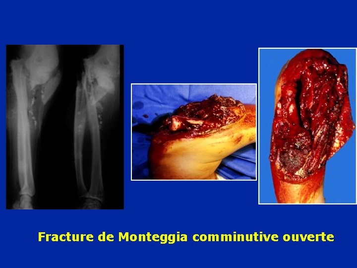 Fracture de Monteggia comminutive ouverte 