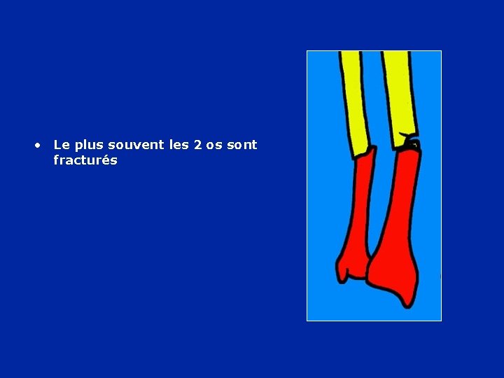  • Le plus souvent les 2 os sont fracturés 