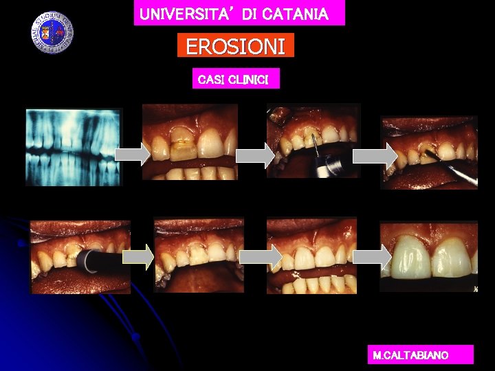 UNIVERSITA’ DI CATANIA EROSIONI CASI CLINICI M. CALTABIANO 