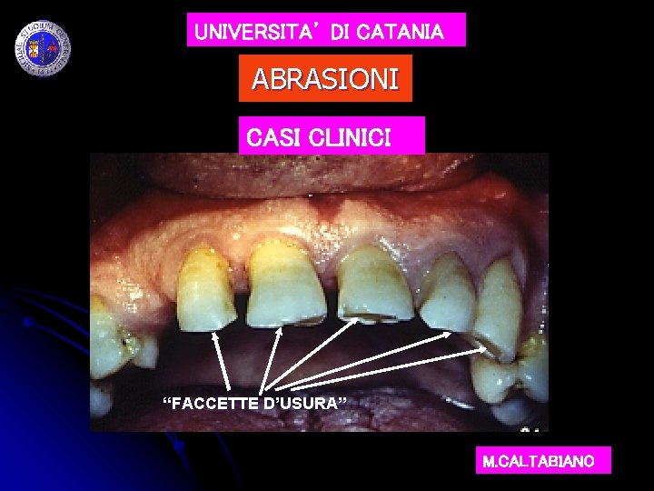 UNIVERSITA’ DI CATANIA ABRASIONI CASI CLINICI “FACCETTE D’USURA” M. CALTABIANO 