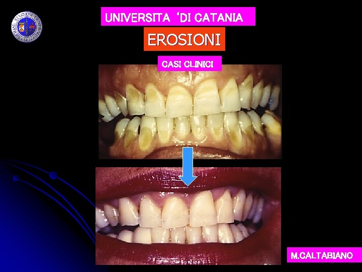 UNIVERSITA ‘DI CATANIA EROSIONI CASI CLINICI M. CALTABIANO 