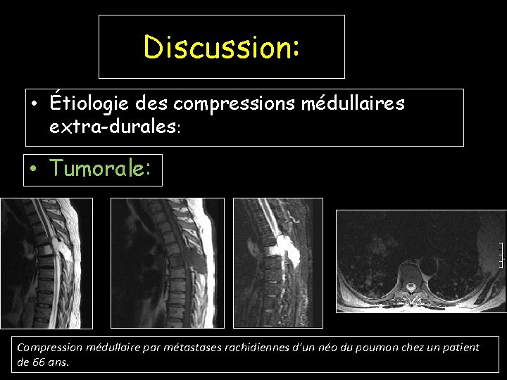 Discussion: • Étiologie des compressions médullaires extra-durales: • Tumorale: Compression médullaire par métastases rachidiennes