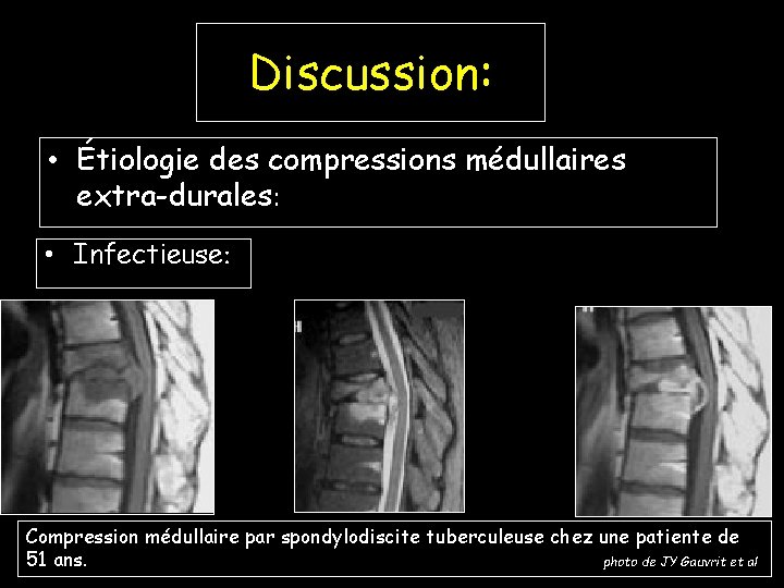 Discussion: • Étiologie des compressions médullaires extra-durales: • Infectieuse: Compression médullaire par spondylodiscite tuberculeuse