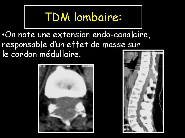 TDM lombaire: • On note une extension endo-canalaire, responsable d’un effet de masse sur