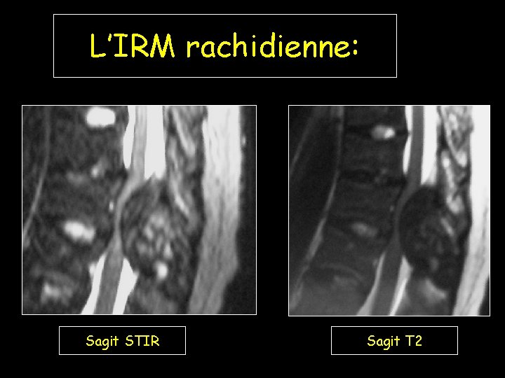 L’IRM rachidienne: Sagit STIR Sagit T 2 
