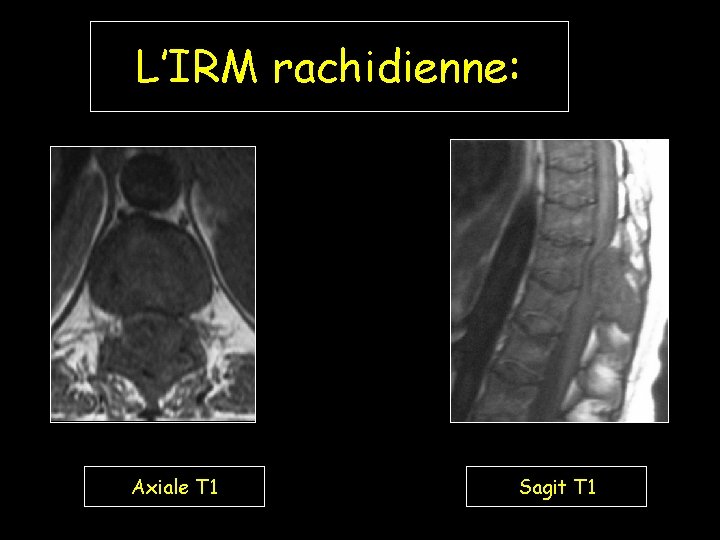 L’IRM rachidienne: Axiale T 1 Sagit T 1 