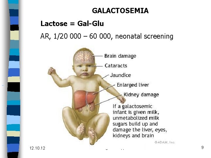 GALACTOSEMIA Lactose = Gal-Glu AR, 1/20 000 – 60 000, neonatal screening 12. 10.