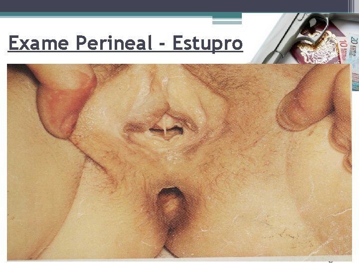 Exame Perineal - Estupro Page 11 
