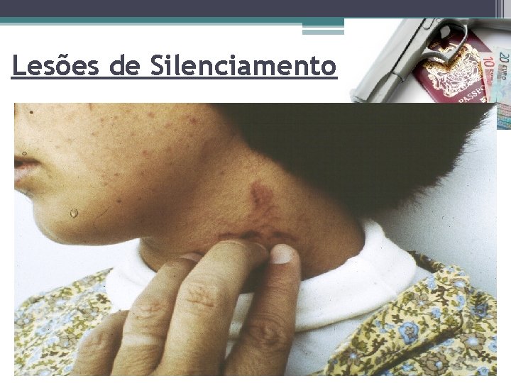 Lesões de Silenciamento Page 7 