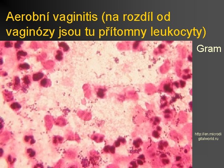 Aerobní vaginitis (na rozdíl od vaginózy jsou tu přítomny leukocyty) Gram http: //en. microdi