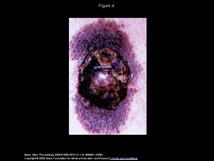 Figure 4 Mayo Clinic Proceedings 2006 81500 -507 DOI: (10. 4065/81. 4. 500) Copyright