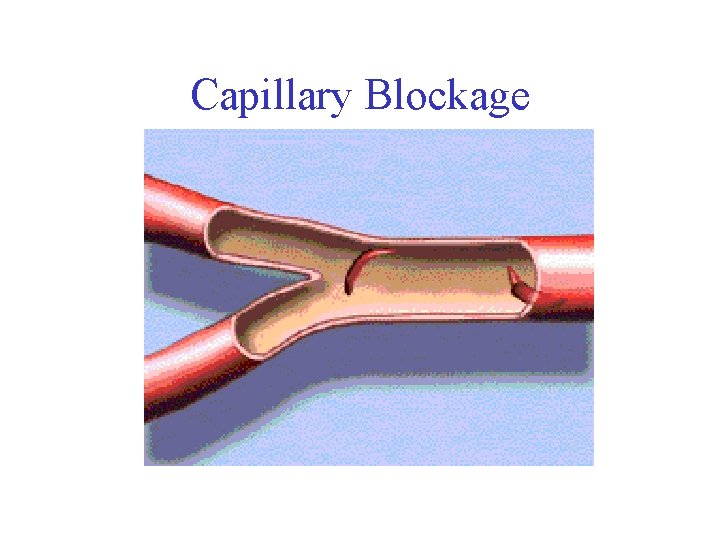 Capillary Blockage 