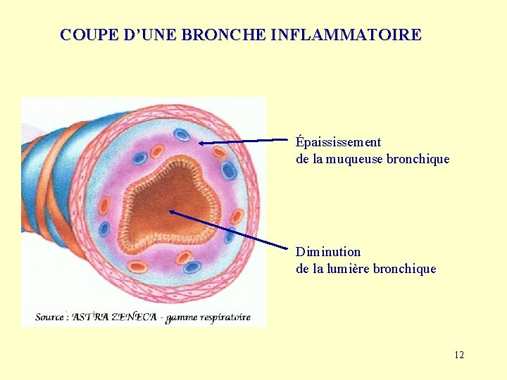 COUPE D’UNE BRONCHE INFLAMMATOIRE Épaississement de la muqueuse bronchique Diminution de la lumière bronchique