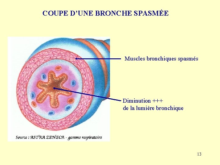 COUPE D’UNE BRONCHE SPASMÉE Muscles bronchiques spasmés Diminution +++ de la lumière bronchique 13