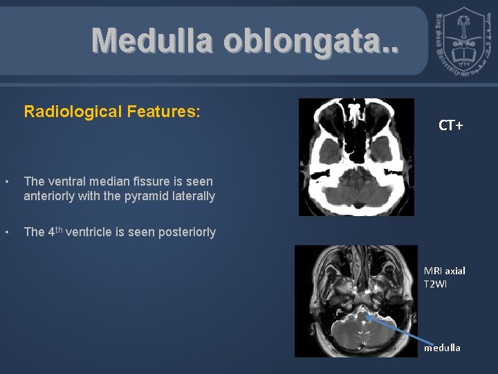 Medulla oblongata. . Radiological Features: • The ventral median fissure is seen anteriorly with