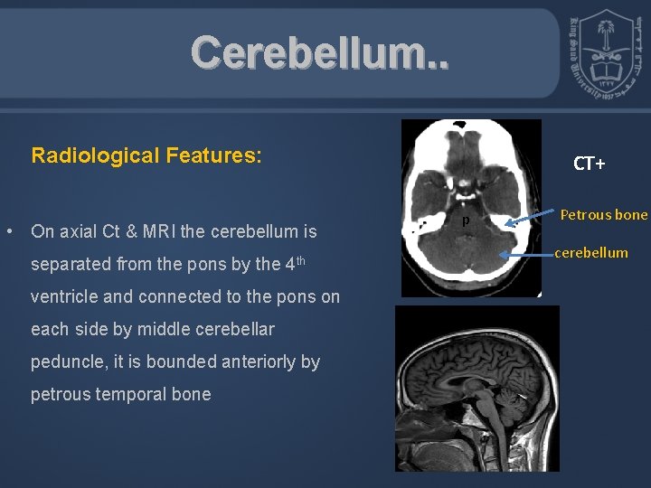 Cerebellum. . Radiological Features: • On axial Ct & MRI the cerebellum is separated
