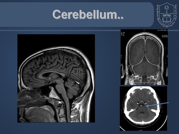 Cerebellum. . 