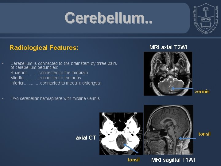 Cerebellum. . Radiological Features: • MRI axial T 2 WI Cerebellum is connected to