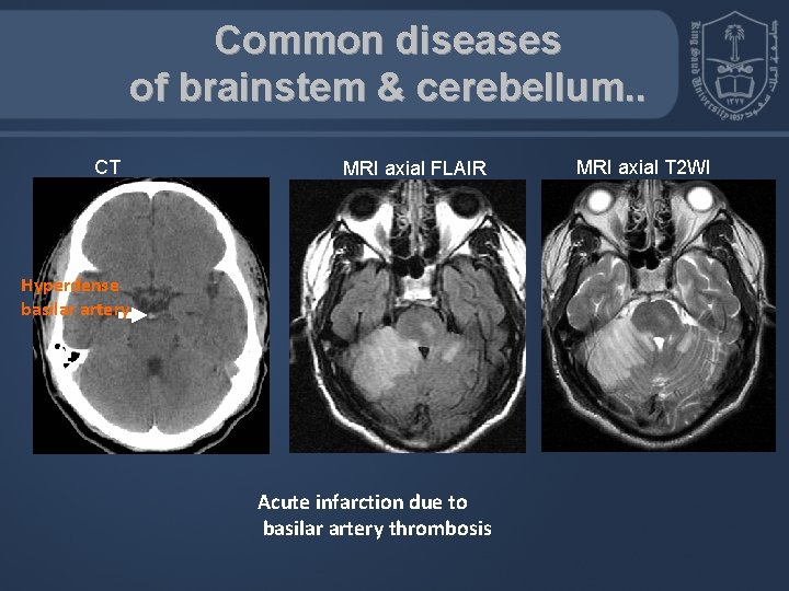 Common diseases of brainstem & cerebellum. . CT MRI axial FLAIR Hyperdense basilar artery