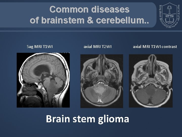 Common diseases of brainstem & cerebellum. . Sag MRI T 1 WI axial MRI