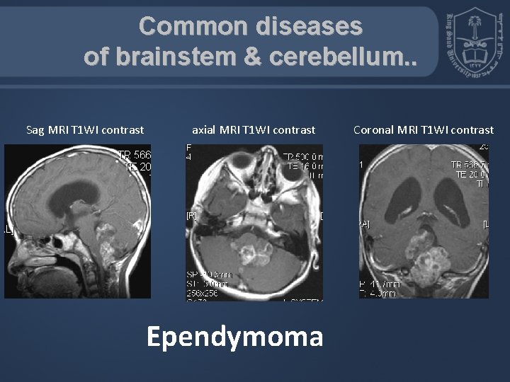 Common diseases of brainstem & cerebellum. . Sag MRI T 1 WI contrast axial