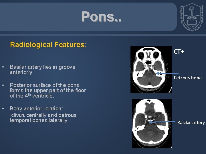 Pons. . Radiological Features: • Basilar artery lies in groove anteriorly • Posterior surface