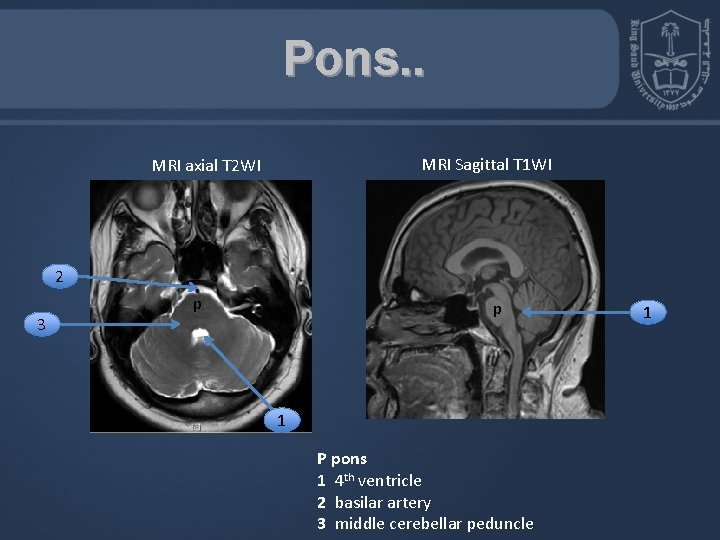 Pons. . MRI Sagittal T 1 WI MRI axial T 2 WI 2 3