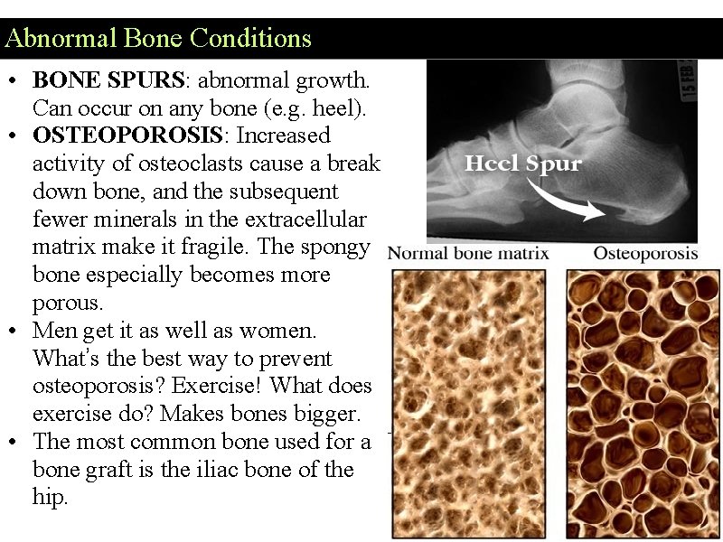 Abnormal Bone Conditions • BONE SPURS: abnormal growth. Can occur on any bone (e.
